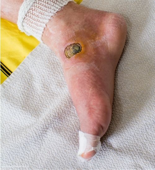 Diyabetik Yara Tedavisi Neden Uzmanlık Gerektirir?