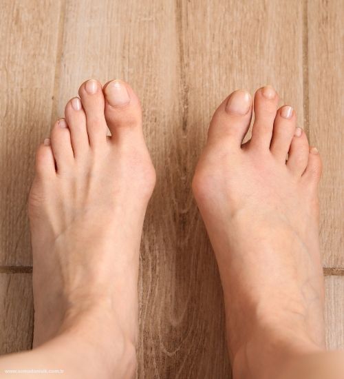 Hallux Valgus (Başparmak Çıkıntısı) Tedavisi Samsun Fizyoterapi