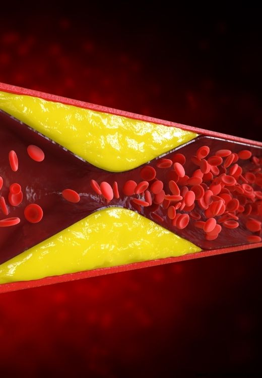 Hiperlipidemi Tedavisinde Fizyoterapi Samsun
