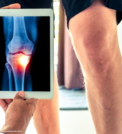 Kireçlenme Osteoartrit Tedavisi Samsun Fizyoterapi