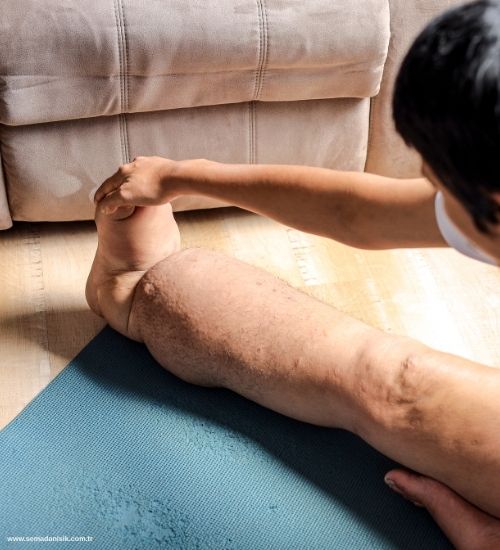 Lenfödem (Fil Hastalığı) Tedavisi Samsun Fizyoterapi