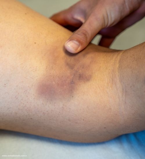 Lif Kopması Kas Yırtılması Tedavisi Samsun