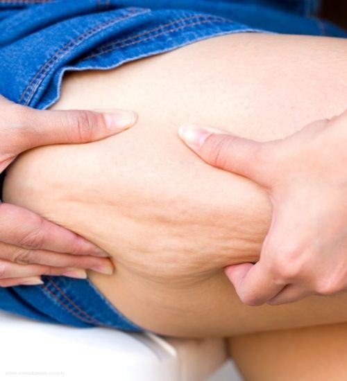 Lipolenfödem Nedir?