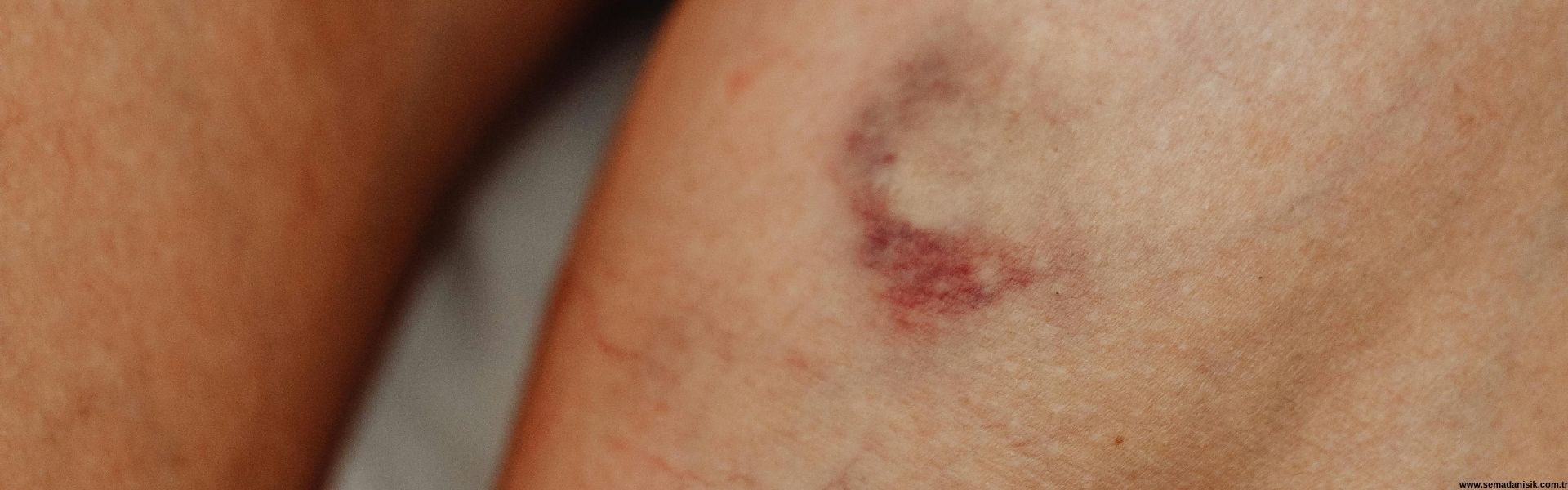 Samsun Kronik Yara Tedavisi