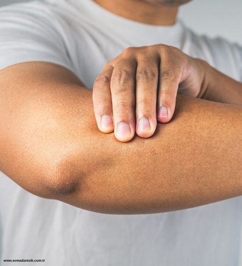 Tenisçi Dirseği Nedir? (Lateral Epikondilit)