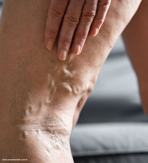 Varis Nasıl Tedavi Edilir? Fizyoterapist Yaklaşımı