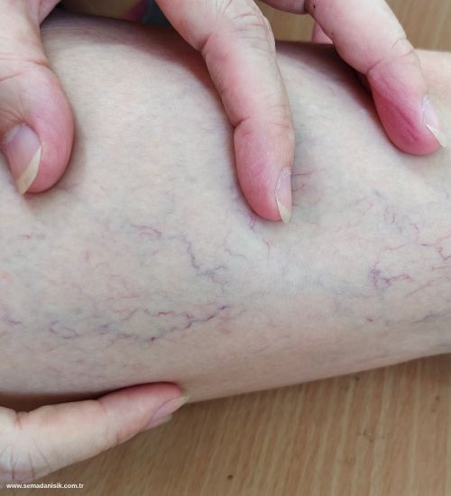 Varis Nedir? Neden Oluşur? Belirtileri Nelerdir?