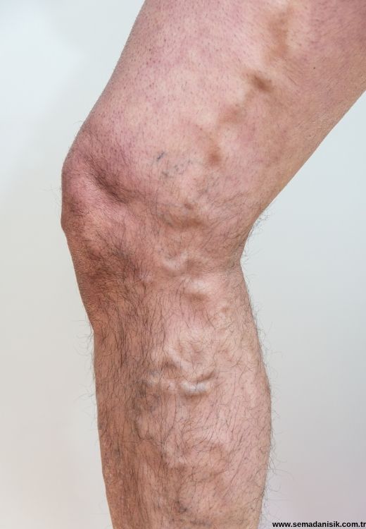 Varis Tedavisi Samsun