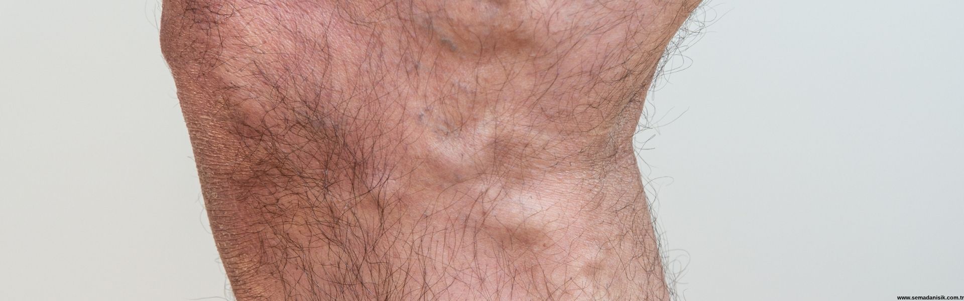 Varis Tedavisi Samsun