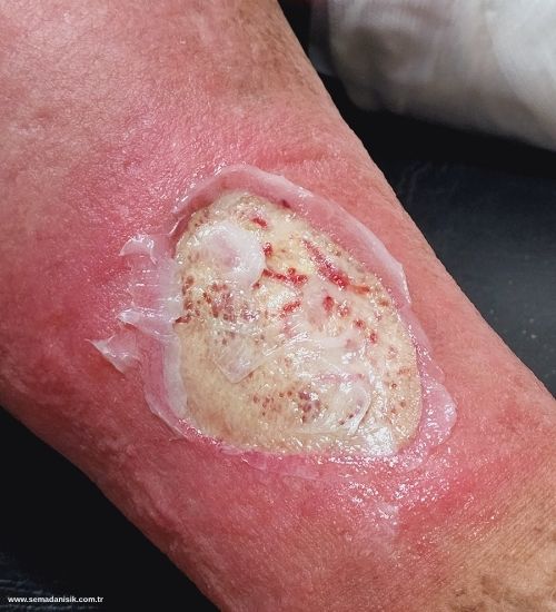 Venöz Ülser Nedir?