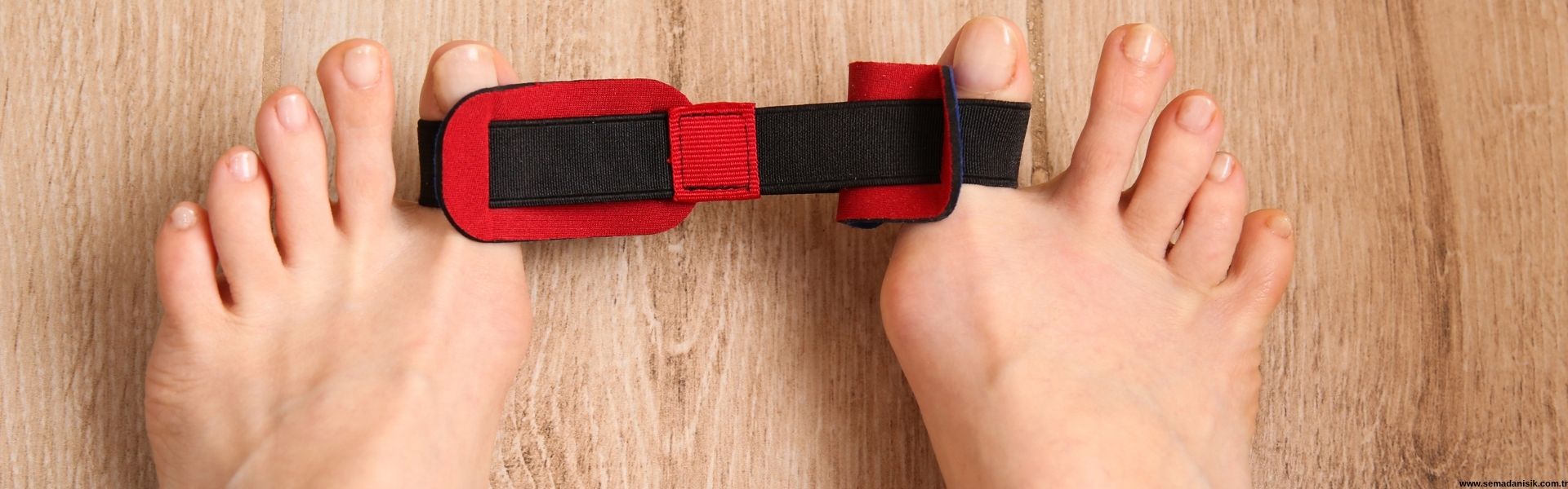 Hallux Valgus Başparmak Çıkıntısı Tedavisi Samsun