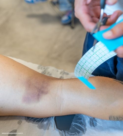 Kas Yırtılması Nasıl Tedavi Edilir? Fizyoterapi Çözümleri