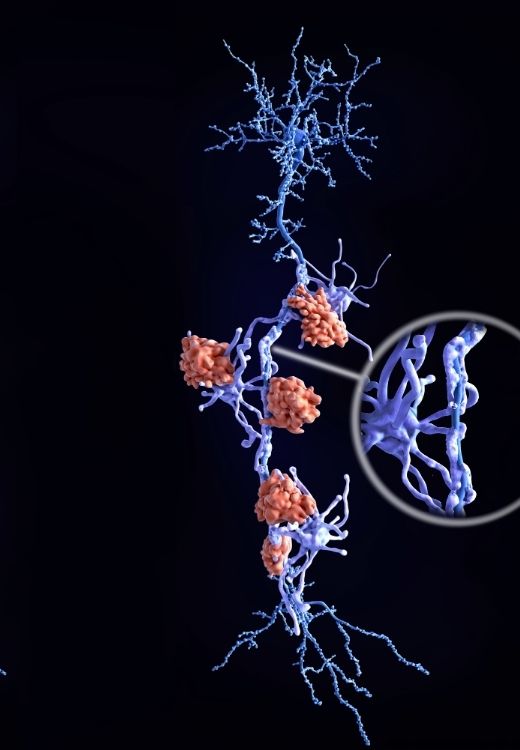 Multipl Skleroz (MS) Tedavisi Samsun