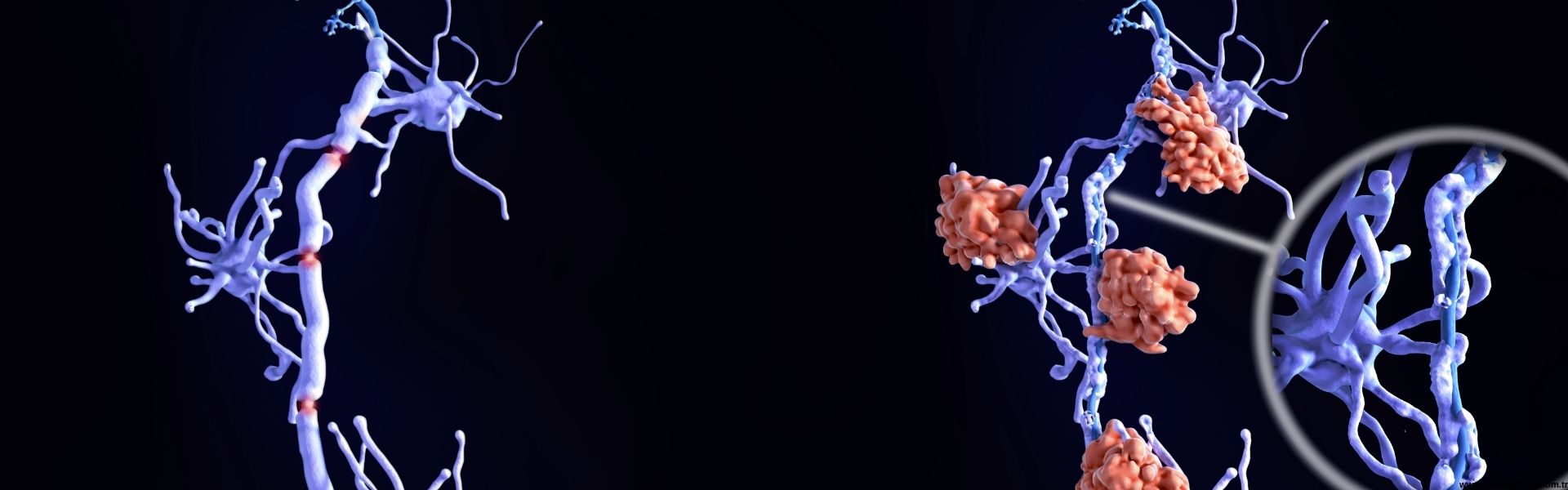 Multipl Skleroz (MS) Tedavisi Samsun