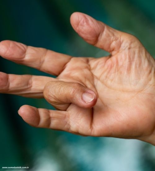 Tetik Parmak Tedavisi Nedir ve Nasıl Tedavi Edilir?